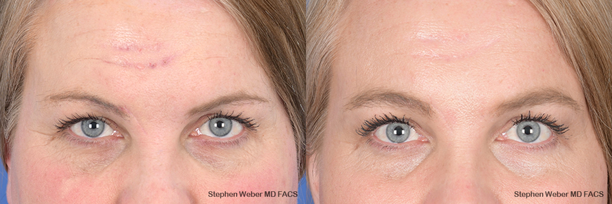 Brow Lift Before And After Weber Facial Plastic Surgery