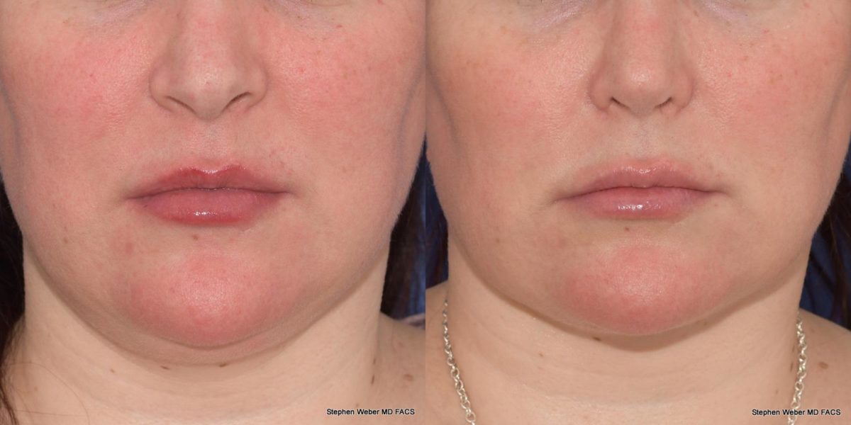 Buccal Fat Pad Removal Before and After 01