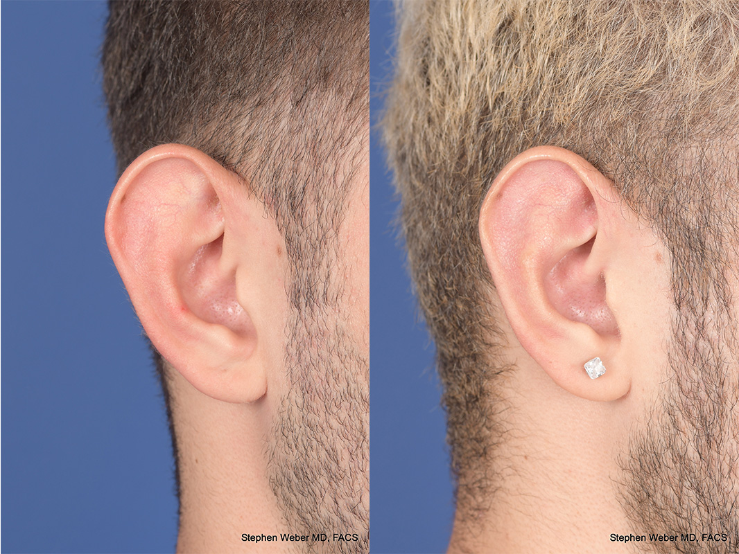 Facial Plastic Surgery for Men Before and After Photo Gallery, Denver, CO