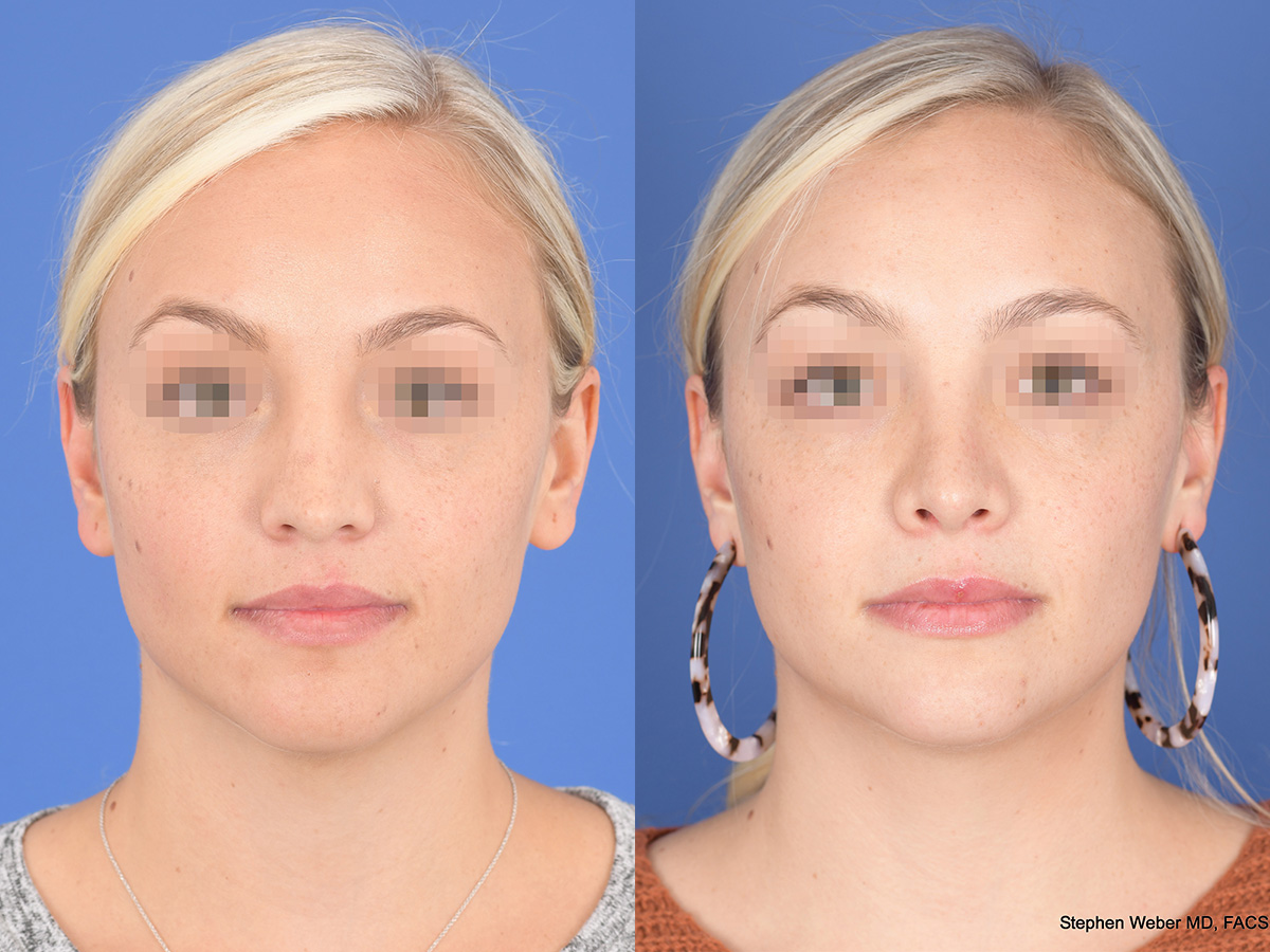 Rhinoplasty Before And After 51 Weber Facial Plastic Surgery